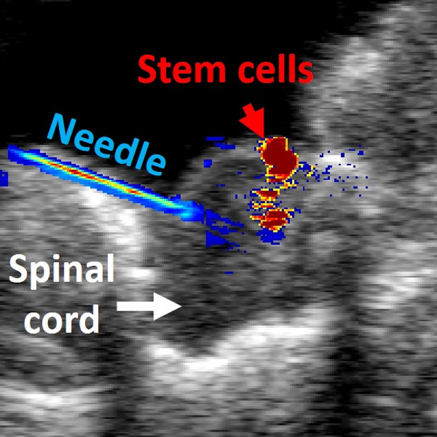 Guiding and Monitoring Stem Cell Therapies in Spinal Cord